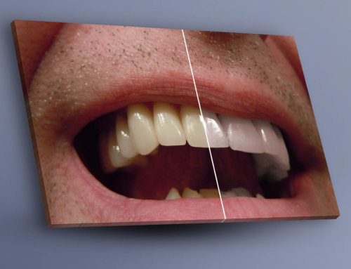 Photo Editing: Teeth Whitening